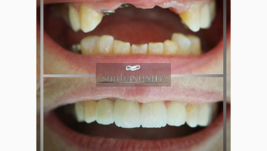 صورة توضيحية - جراح تجميل الأسنان د. حبيب ظريفه يتحدث عن محاسن زراعة الأسنان في يوم واحد